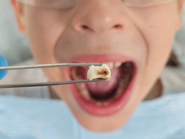 Best Emergency Tooth Extraction in Hastings, NE